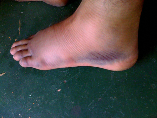 bruise on top of foot no reason